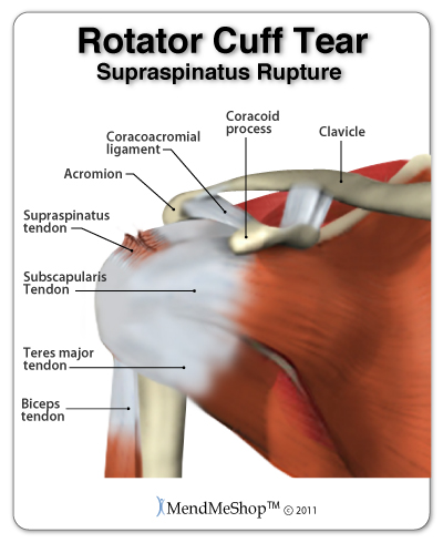 rotator-cuff-supraspinatus-tendon-tear